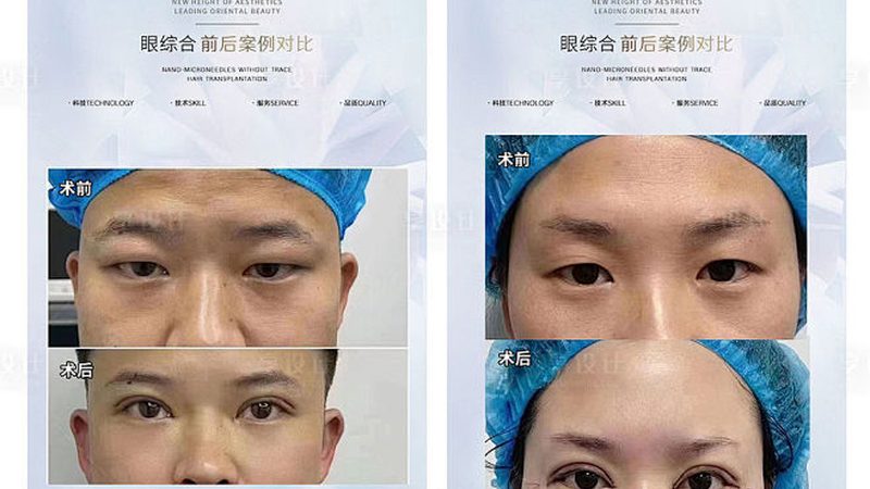 脱毛仪波长参数对皮肤的影响