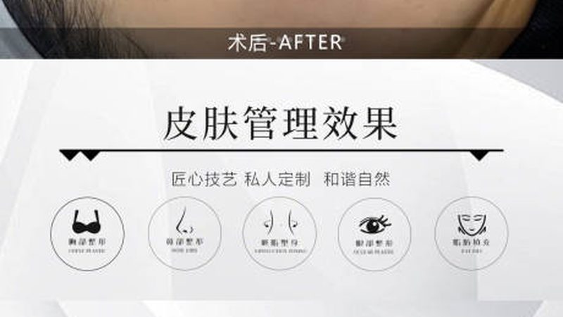小标题：隆鼻，不仅仅是鼻子变挺