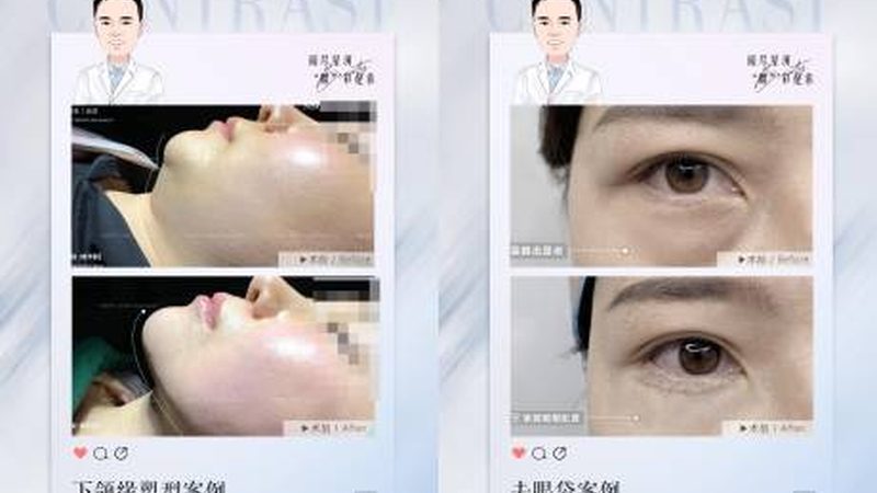 2024年鼻假体品牌排行榜：揭秘热门品牌背后的技术秘密