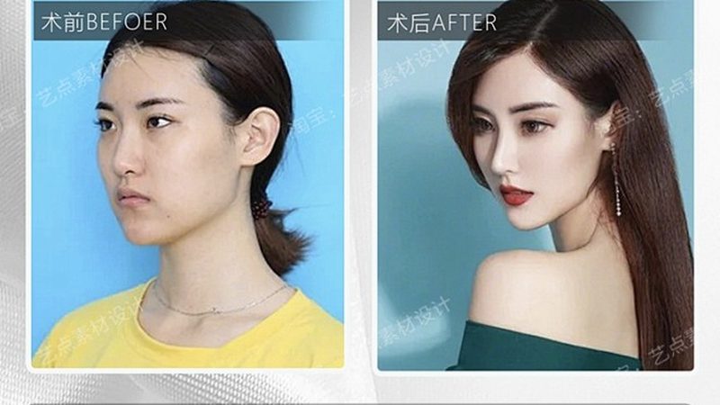 光子嫩肤后反黑现象，了解真相才能安心变美
