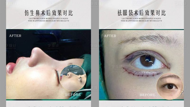 小标题：割双眼皮，常见误区盘点