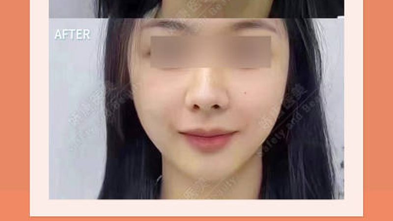 厦门双眼皮修复术后，如何护理才能加速恢复？**