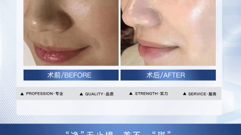 玻尿酸代理加盟多少钱