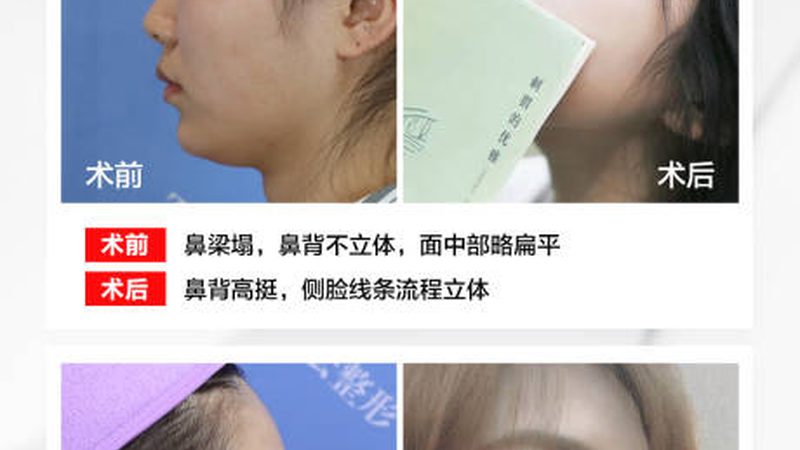 国产光子嫩肤仪：揭秘其原理与选购要点