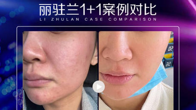 下颌角截骨不是越薄越好，这些风险你必须知道