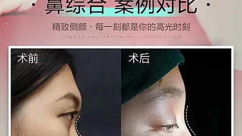 揭秘抗衰射频仪器：厂家资质背后的标准与奥秘