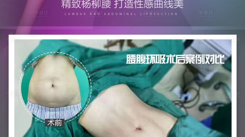 选择双眼皮手术方法时，应考虑以下因素：